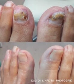 De Nummer 1 Tegen Schimmelnagels! - HFL - Laboratories - Solution Spray - 50ml + Dadi'Oil Nagelriem Olie - 3.75ml - Kalknagel Spray - Schimmelnagel Spray - Nagelriem Olie - Nagelverzorging -Verzorgings Producten Winkel 1065x1200