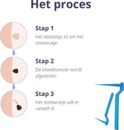 Steelwratjes Verwijderaar - Steelwratjes Verwijderen - Pijnloos En Snel - Wrattenverwijderaar - Steelwratten -Verzorgings Producten Winkel 1154x1200