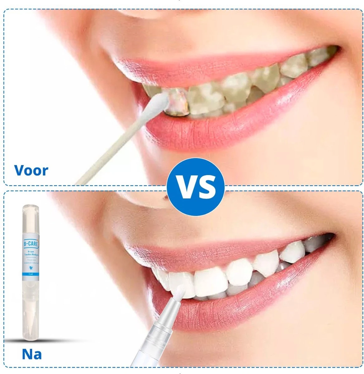 B-care Tanden Bleekpen - Teeth Whitening Pen - Tanden Bleker - Wittere Tanden - Teeth Whitening Strips - Professioneel Resultaat - Tandsteen Verwijderaar - Zonder Peroxide - Tandenbleekset - Tanden Bleken 2 B-care Tanden Bleekpen - Teeth Whitening Pen - Tanden Bleker - Wittere Tanden - Teeth Whitening Strips - Professioneel Resultaat - Tandsteen Verwijderaar - Zonder Peroxide - Tandenbleekset - Tanden Bleken - Afbeelding 2