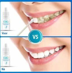 B-care Tanden Bleker – Wittere Tanden – Teeth Whitening Strips – Professioneel Resultaat - Tandsteen Verwijderaar - Zonder Peroxide - Tandenbleekset - Tanden Bleken -Verzorgings Producten Winkel 1177x1200 7