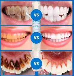 B-care Tanden Bleekpen - Teeth Whitening Pen - Tanden Bleker - Wittere Tanden - Teeth Whitening Strips - Professioneel Resultaat - Tandsteen Verwijderaar - Zonder Peroxide - Tandenbleekset - Tanden Bleken 21 B-care Tanden Bleekpen - Teeth Whitening Pen - Tanden Bleker - Wittere Tanden - Teeth Whitening Strips - Professioneel Resultaat - Tandsteen Verwijderaar - Zonder Peroxide - Tandenbleekset - Tanden Bleken -Verzorgings Producten Winkel 1181x1200 5