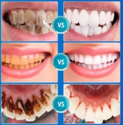 B-care Tanden Bleker – Wittere Tanden – Teeth Whitening Strips – Professioneel Resultaat - Tandsteen Verwijderaar - Zonder Peroxide - Tandenbleekset - Tanden Bleken -Verzorgings Producten Winkel 1181x1200 6