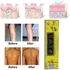 Psoriasis/exzeem Chineese Creme -Verzorgings Producten Winkel 1195x1200 7