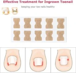 Merkloos Ingegroeide Teennagel Corrector -Verzorgings Producten Winkel 1200x1146
