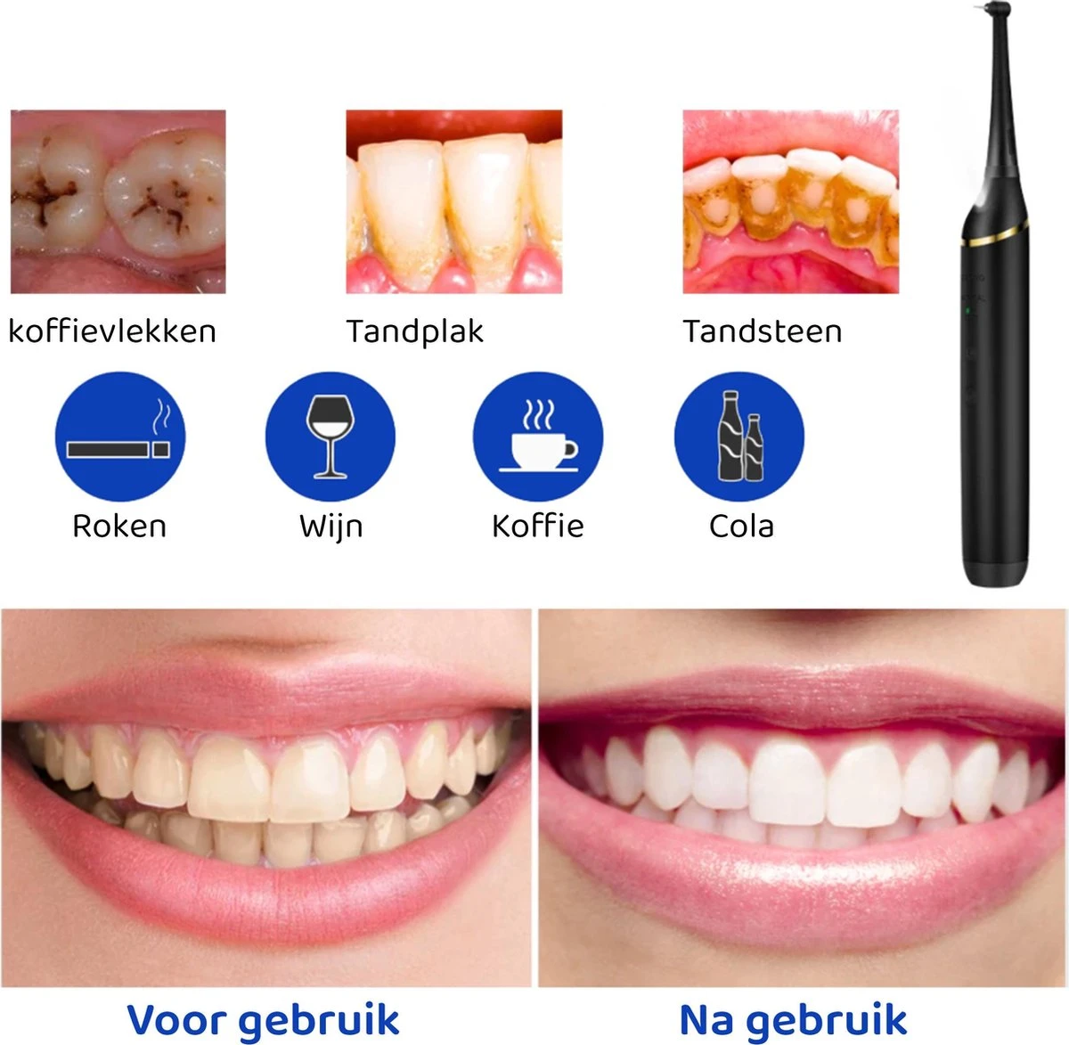 ExCorn Elektrische Tandsteen Verwijderaar - Inclusief 6-delig Tandartsset - 3 Standen - Elektrisch Tandplak Verwijderen - Tanden Polijsten 4 ExCorn Elektrische Tandsteen Verwijderaar - Inclusief 6-delig Tandartsset - 3 Standen - Elektrisch Tandplak Verwijderen - Tanden Polijsten - Afbeelding 4