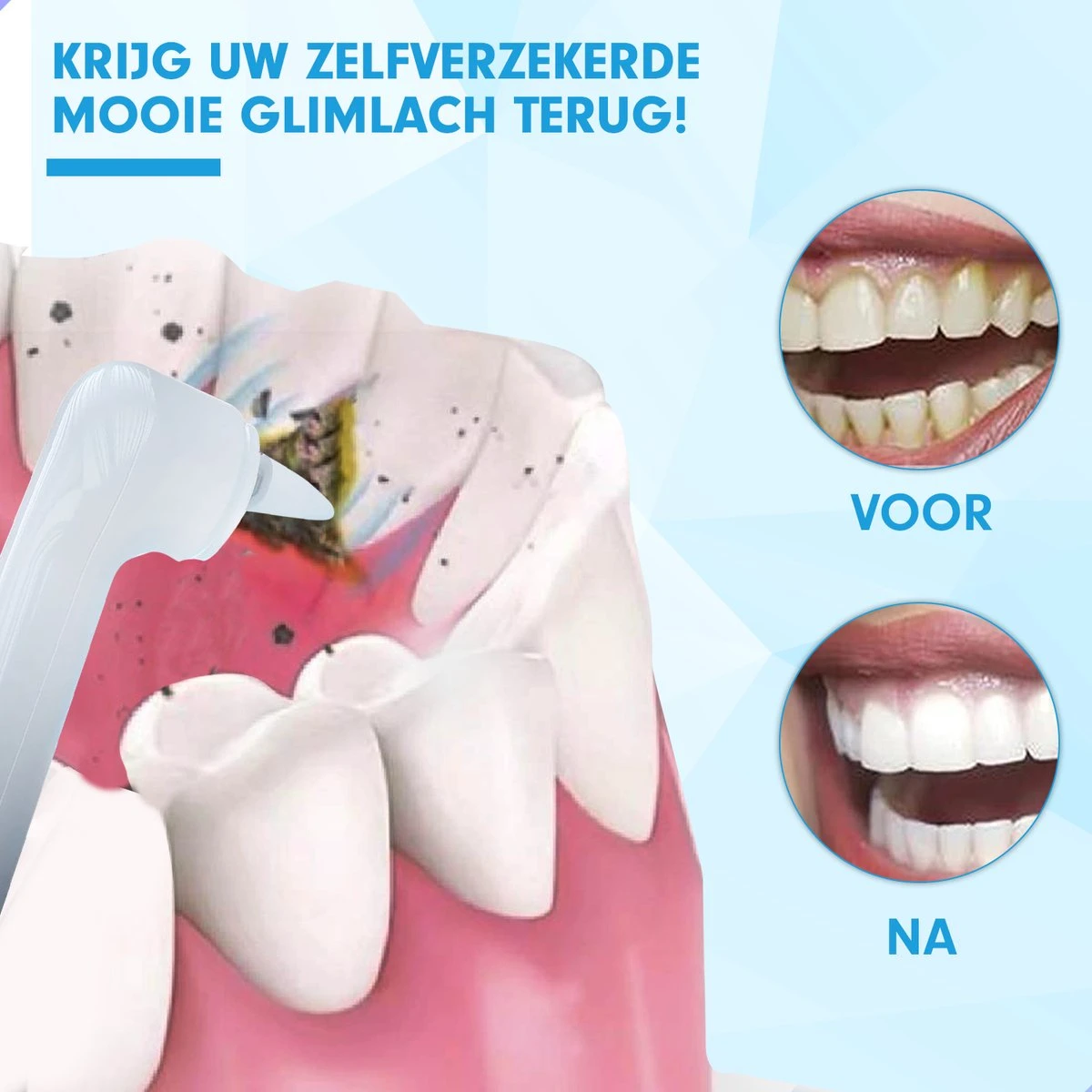 DEN-T® PRO P350 Elektrische Tandenpolijster - Wit - 5 Standen - 5 Opzetstukken - Polijstmachine - Polijstset - Tanden Polijsten - 5 DEN-T® PRO P350 Elektrische Tandenpolijster - Wit - 5 Standen - 5 Opzetstukken - Polijstmachine - Polijstset - Tanden Polijsten - - Afbeelding 5