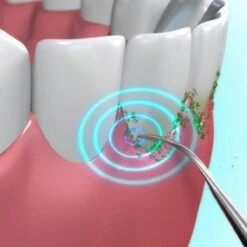 Toppers Van TV - Sonic Tandsteenverwijderaar - Tandplakverwijderaar -Verzorgings Producten Winkel 1200x1200 1900