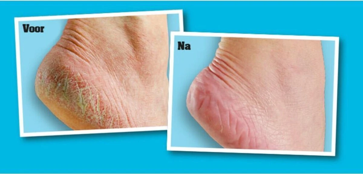 O'Keeffe's - Voetencreme - Voor Gezonde Voeten - Potje 96 Gram 2 O'Keeffe's - Voetencreme - Voor Gezonde Voeten - Potje 96 Gram - Afbeelding 2