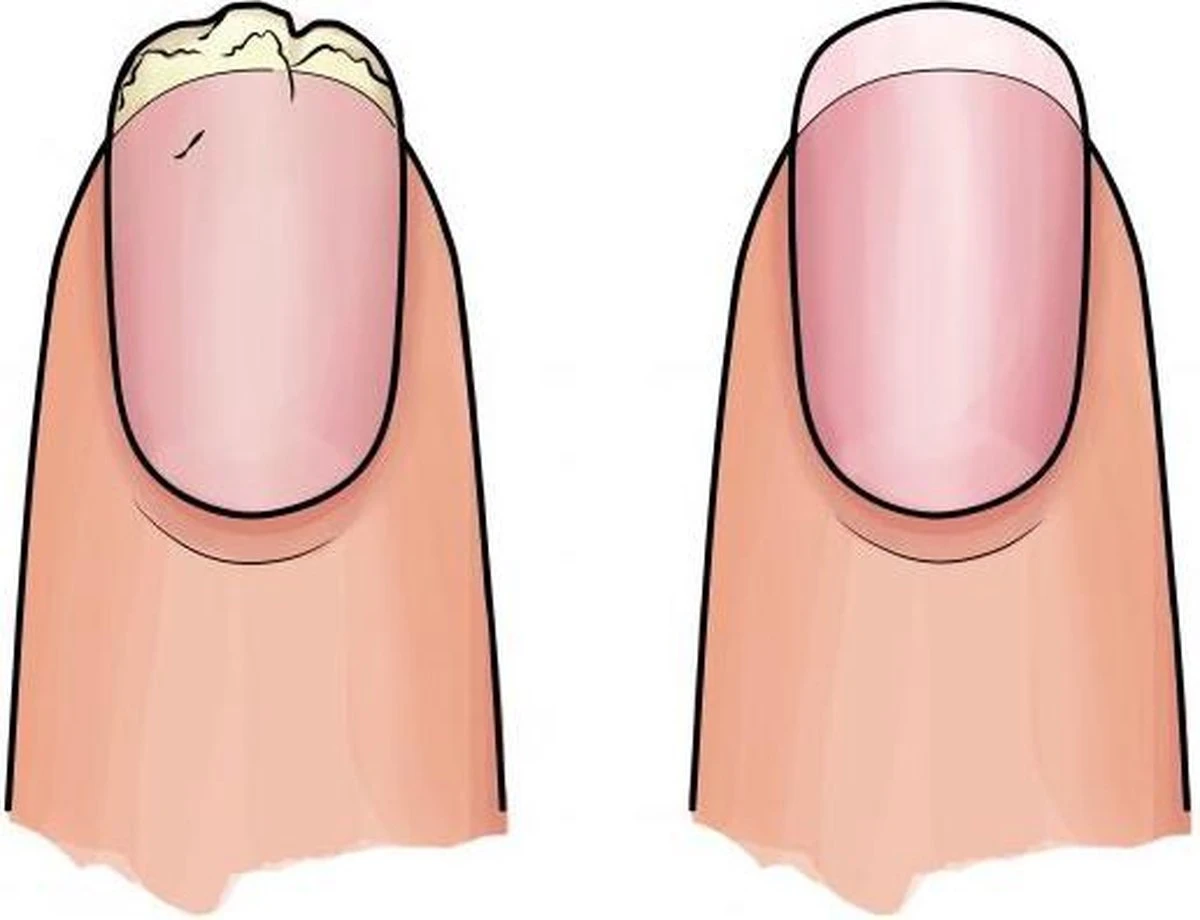 Herome 3 In 1 Manicure Nagelverzorging Set Blauw – Nagelset Voor Beschadigde Nagels - Nagelverharder, Nagellakremover En Nagelriemcreme - Set Van 3 3 Herome 3 In 1 Manicure Nagelverzorging Set Blauw – Nagelset Voor Beschadigde Nagels - Nagelverharder, Nagellakremover En Nagelriemcreme - Set Van 3 - Afbeelding 3