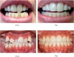 Edoir Rechte Tanden Beugel - Retainer Voor Rechte Tanden - Rechte Tanden Bitje -Verzorgings Producten Winkel 1200x929 1